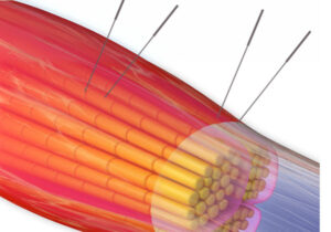 鍼は筋膜・筋肉まで届く