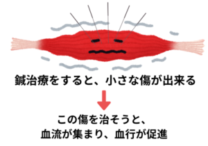 鍼の作用　血流促進
