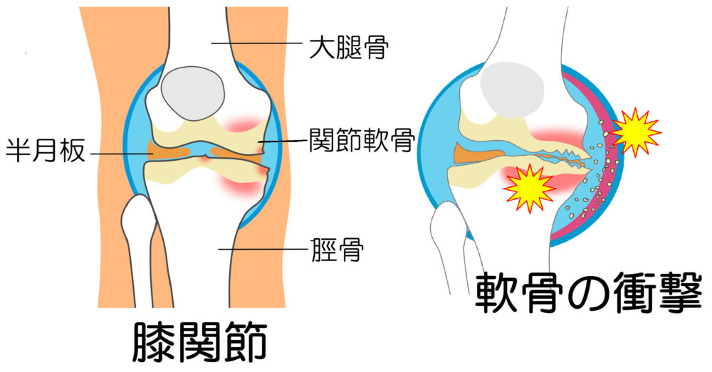 膝関節の軟骨の構造図と関節軟骨への衝撃イメージ