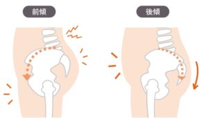 骨盤のゆがみ