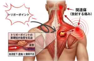 トリガーポイントは血行不良や関連痛の原因に繋がる